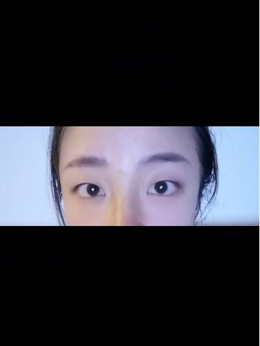 西安时光整形郭淑华双眼皮案例分享，一个月就这么自然