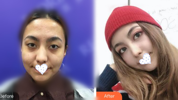 徐州时光洪扬整形双眼皮案例分享，好看到词穷