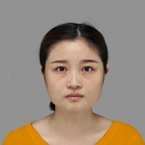 重庆美联臣下颌角整形前