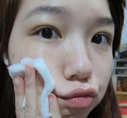 宜昌蕾帝整形张景雷双眼皮案例分享