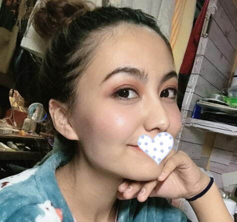 徐州时光洪扬整形双眼皮术后一个月效果