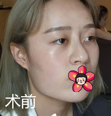 北京基础美下颌角整形术前效果