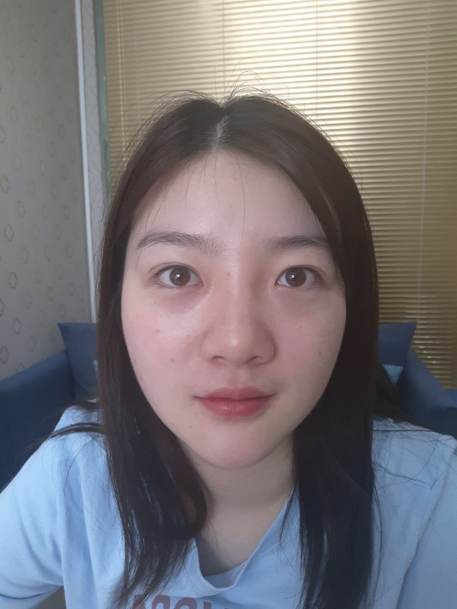 北京圣嘉荣二次鼻修复案例分享，做整形一定不要去莆田系医院