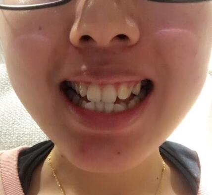 自贡华医口腔金属托槽矫正前