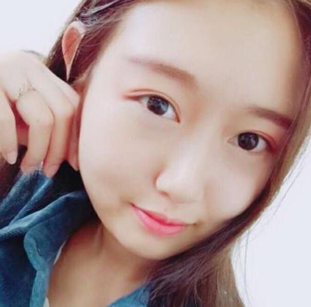 武汉伽美整形刘翼面部吸脂案例分享