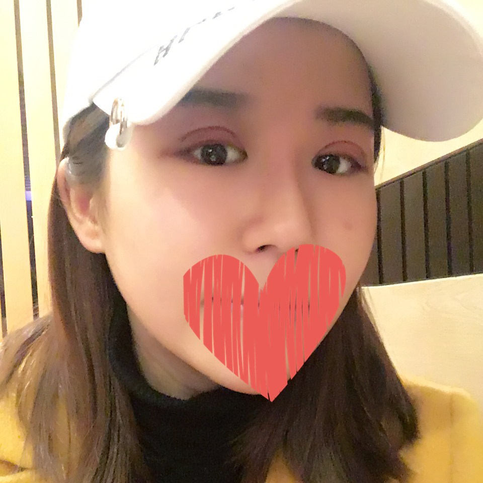 沧州中妤整形张明切开双眼皮拆线后三天效果