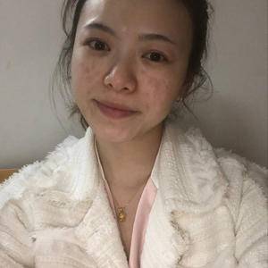 邯郸佑熙整形孙坚激光祛斑前