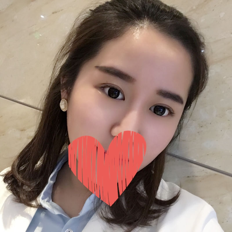 沧州中妤整形张明切开双眼皮两个月效果