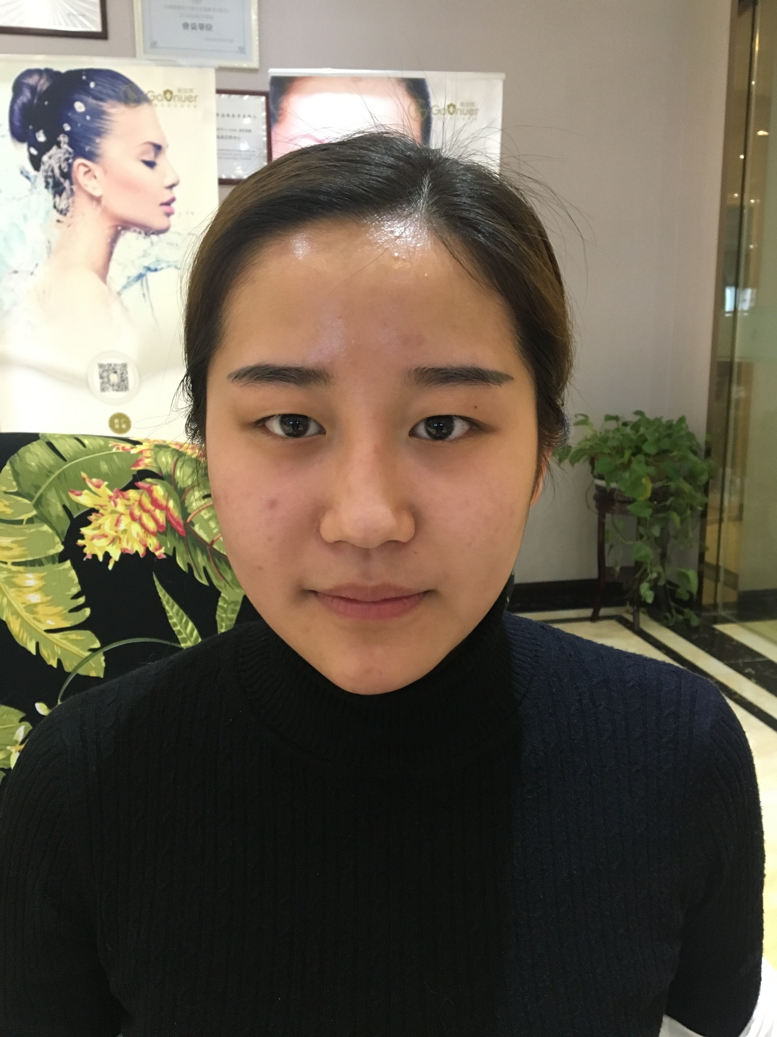 沧州中妤整形张明切开双眼皮前