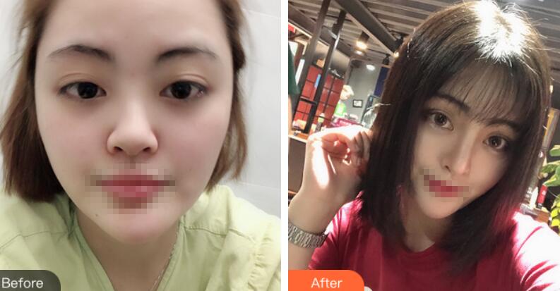 上海赛美瑞整形张化举鼻综合前后对比图