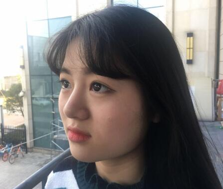 西安希美得整形瘦脸针瘦脸半个月效果反馈