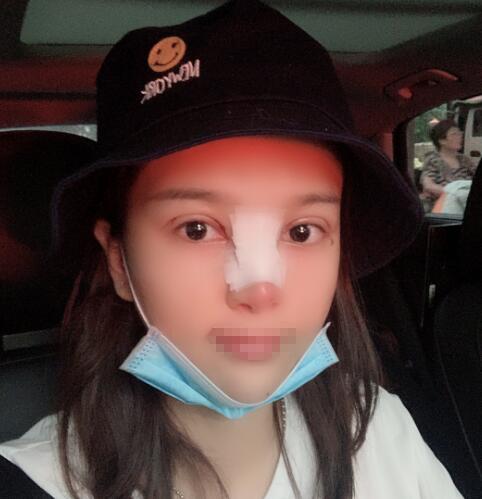 兰州润妍整形鼻综合术后三天效果