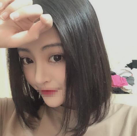 上海赛美瑞整形张化举鼻综合两个月效果