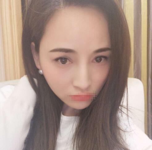 赤峰现代妇产医院医疗美容科袁俊龙双眼皮修复术后两个月