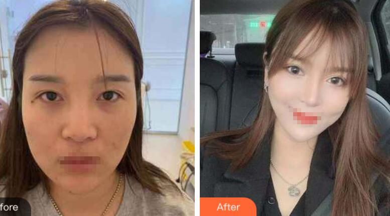 兰州润妍整形鼻综合案例分享