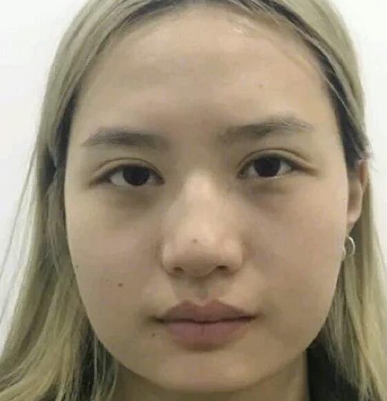 广州中科美整形陈昌华双下巴吸脂案例分享