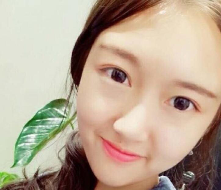 武汉伽美整形刘翼面部吸脂术后一个月效果