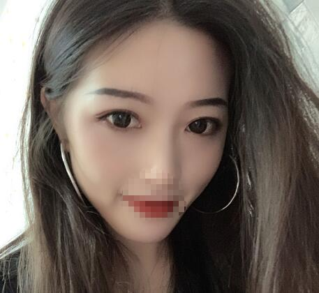 北京美莱整形杜园园双眼皮案例分享