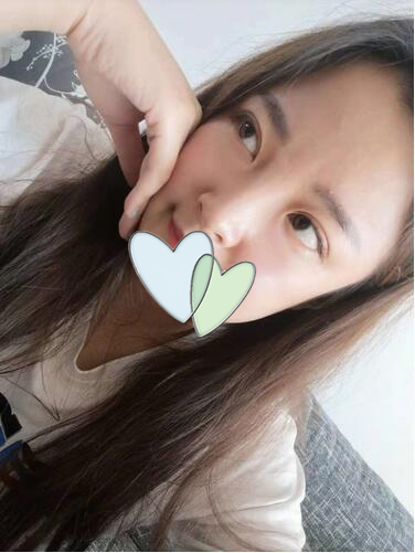 青岛伊美尔刘长发做双眼皮怎么样？