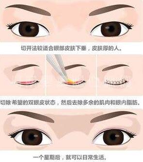 广州广大整形美容医院切开双眼皮术后效果