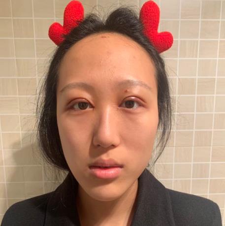 上海华美杨亚益眼部修复前效果图
