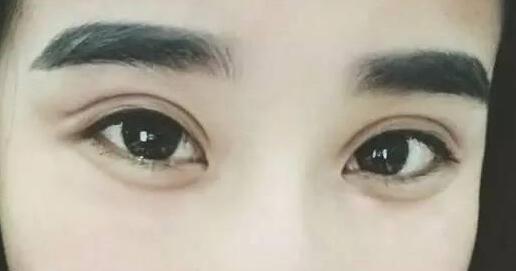 广州爱来埋线双眼皮手术后的效果