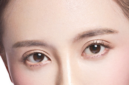 菏泽华美整形美容医院开内眼角术后效果