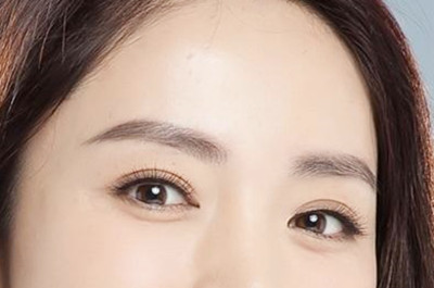 衡阳爱思特医疗美容医院开眼角术后效果