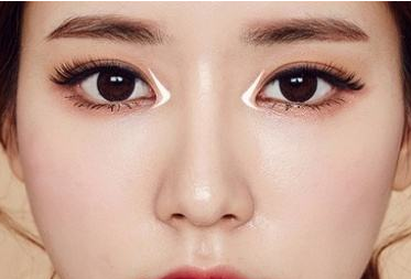 江门侨都华美整形美容医院开内眼角
