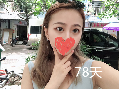 杭州静港林忠泵埋线双眼皮案例1-7天效果图分享，让你的眼睛魅力四射