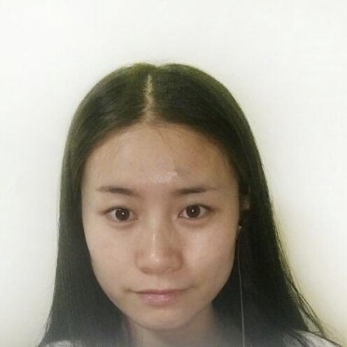 青岛博士王变彩双眼皮案例效果分享