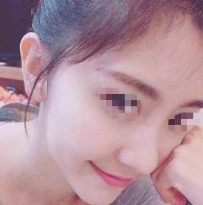 昆明丽都整形医院李裕炯医生耳软骨隆鼻案例分享