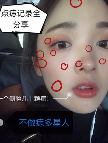 做激光点痣之前的效果