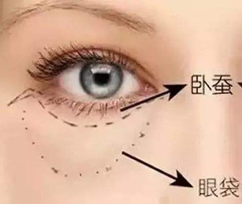南充艾迪整形美容医院吸脂祛眼袋