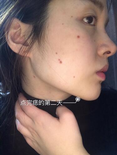激光点痣的第二天