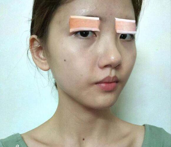 做切开双眼皮手术之前的我