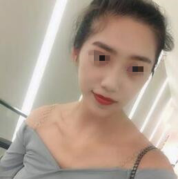 耳软骨隆鼻中