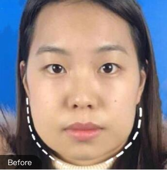 江西省人民医院整形外科熊清华下颌角截骨手术案例分享