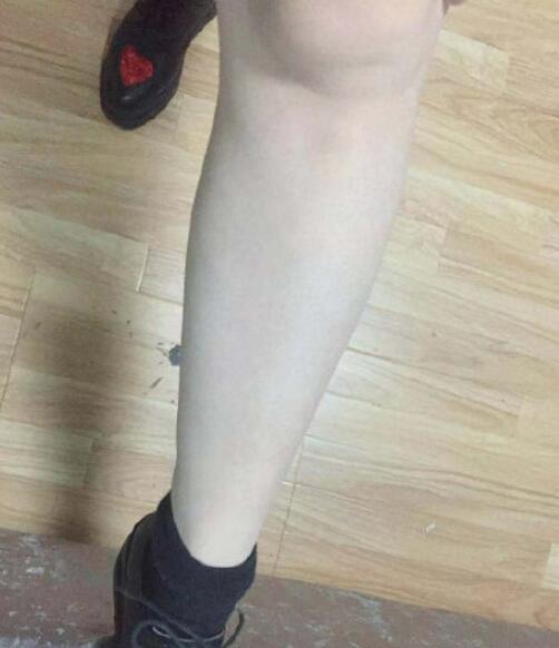 宋君医生激光脱毛手术最终效果图对比
