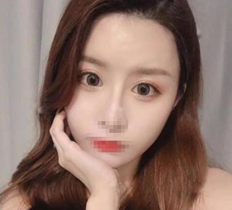 完全恢复后的双眼皮效果