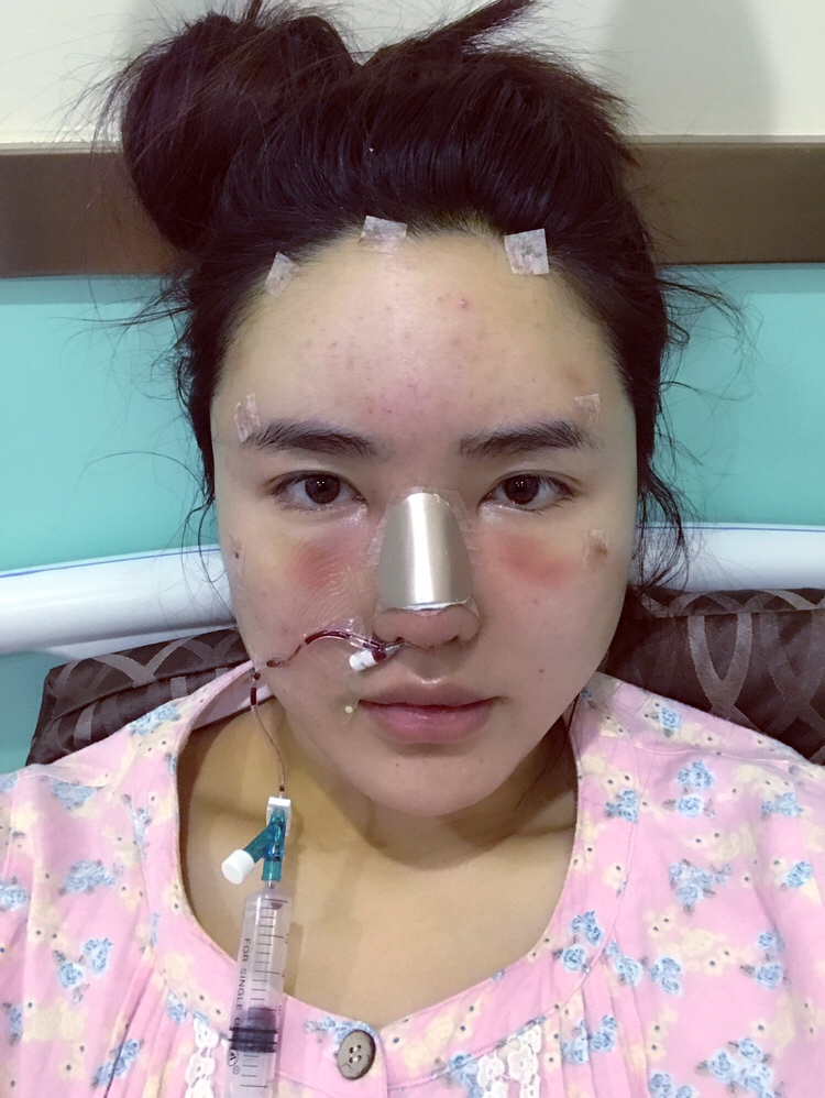 膨体隆鼻手术过程