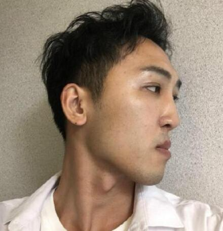 成都恩喜医学整形张晓琴医生男性过大下颌角磨骨案例效果分享