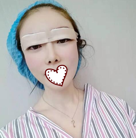 刚做完双眼皮手术，还在恢复过程中