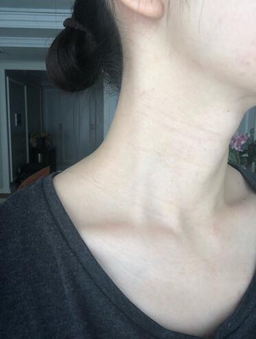 安徽韩美整形医院吴美珍医生液态超声刀去颈纹案例，让你的皮肤回到18岁