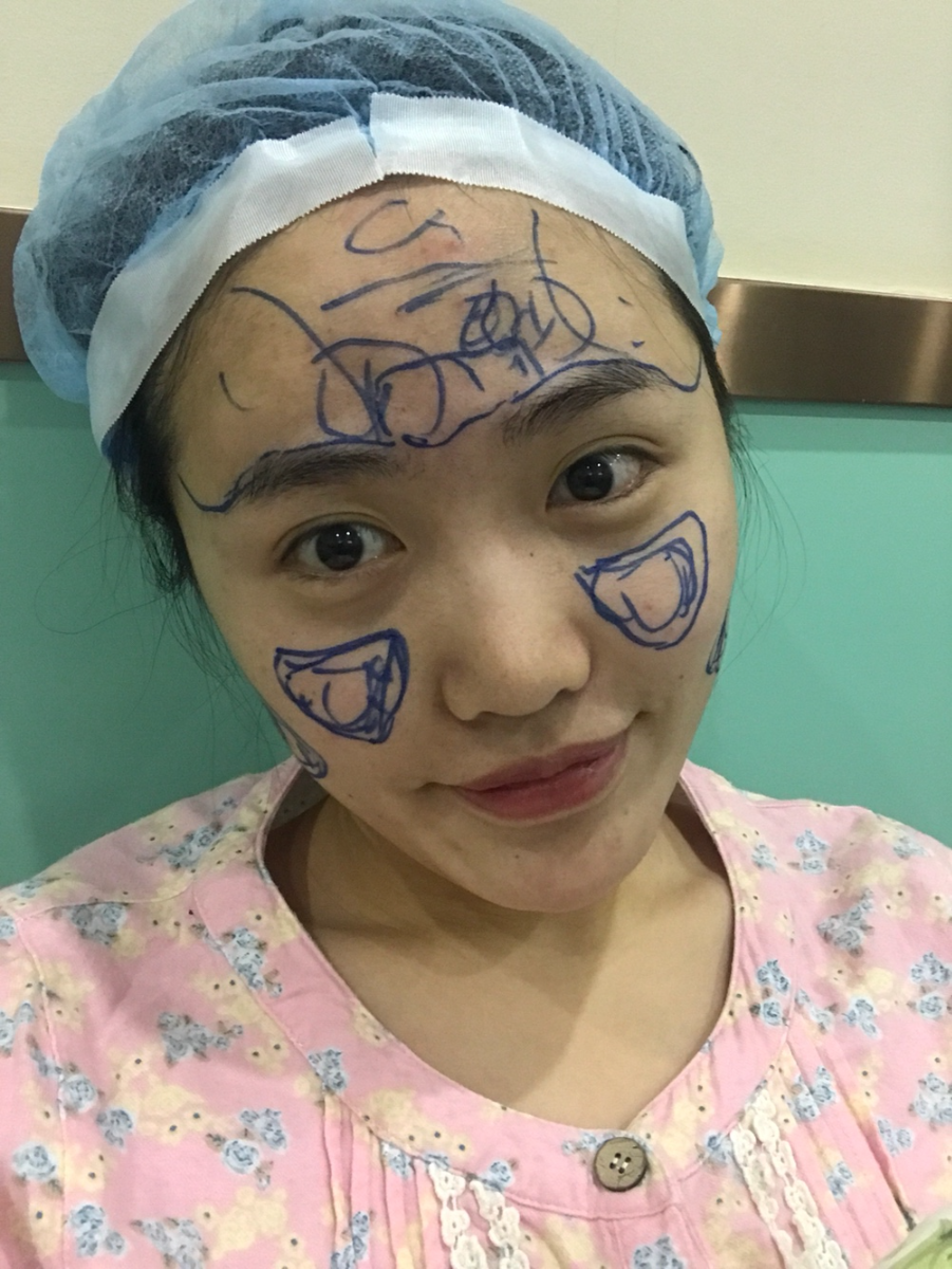 北京星美李宁辉进口膨体隆鼻案例效果对比图，鼻子自然又美丽