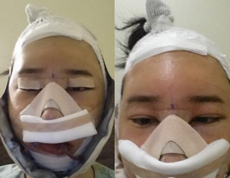重庆三峡中心医院颌面外科张宇下颌角案例手术效果对比图