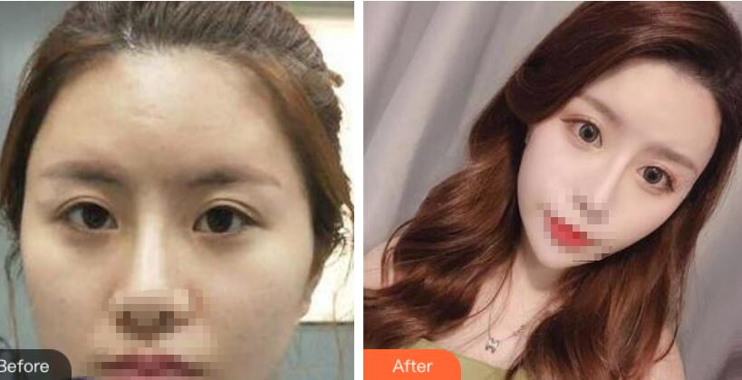 郑州风信子整形美容医院双眼皮案例效果对比图分享
