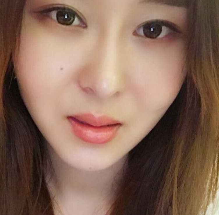 郑州优恩整形王波医生玻尿酸丰唇案例