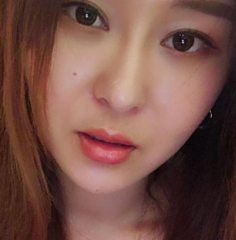 玻尿酸丰唇手术术后效果