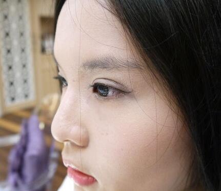 青岛大学医学院整形美容科陈振宇医生做双眼皮怎么样？案例效果太惊艳
